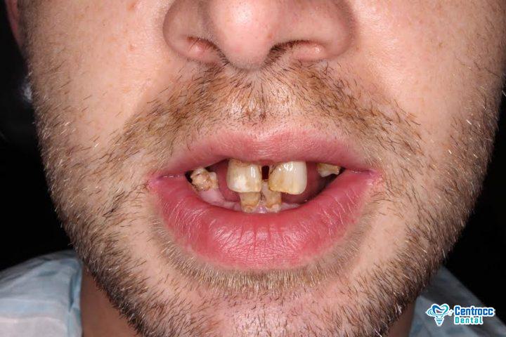 Mit 30 zähne schlechte Zahnarzt