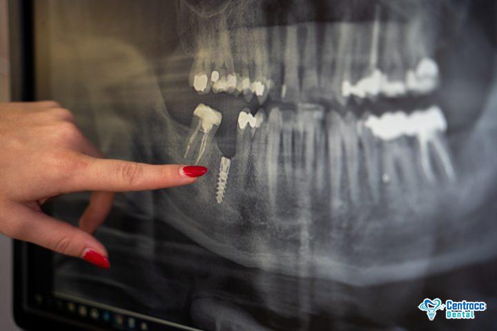 Röntgenbild Zahnimplantat