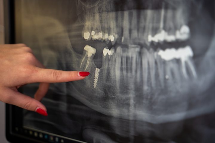 Implantat