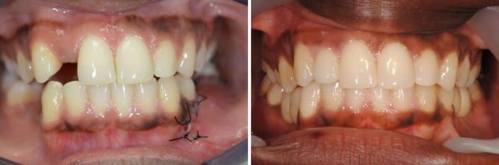 Miniimplantat